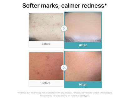Serum 10% ácido azelaico medicube